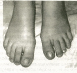Врастание ногтей ног