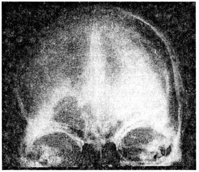 Ангиограмма (прямая проекция) пострадавшего с острой субдуральной гематомой