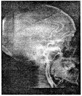 Ангиограмма при локализации очага размозжения в области теменной доли головного мозга
