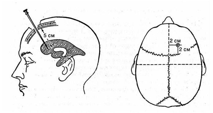 Схема пункции переднего рога бокового желудочка головного мозга