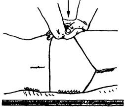 Тест сдавливания Стоддарта, выполняемый в положении больного лежа на боку
