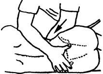 Тест для выявления подвижности крестцово-подвздошного суставе в положении больного лежа на боку