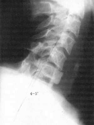 Рентгенограмма после хирургического лечения