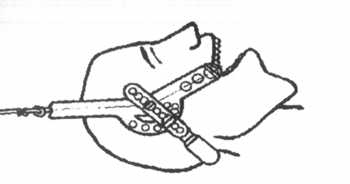Схема фиксации головы специальным устройством для вытяжения шейного отдела позвоночника