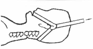 Схема фиксации головы больного лямками для вытяжения шейного отдела позвоночника за основание черепа