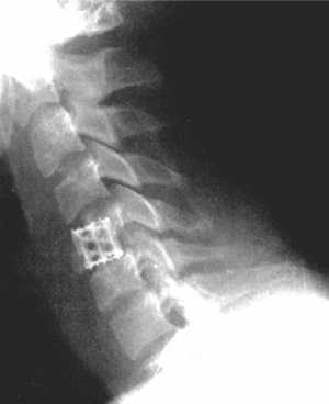 Оскольчатый перелом тела С5-позвонка до операции и после стабилизации металлическим цилиндром