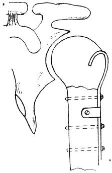 Остеосинтез перелома хирургической шейки плечевой кости пластинкой Каплана