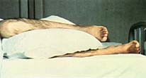 Мягкая подушка между ногами поможет устранить опасность и сделает положение пациента более удобным