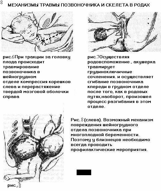 Механизмы травмы позвоночника и скелета в родах