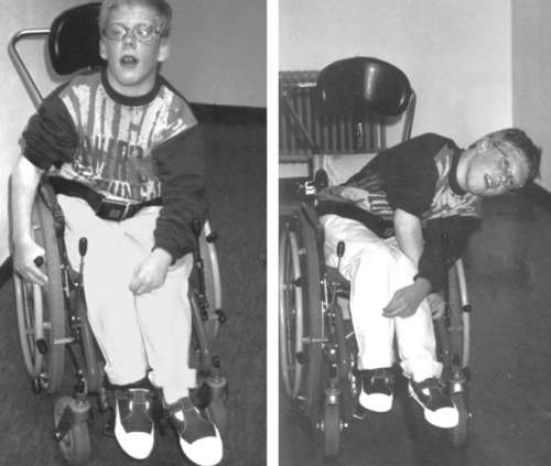 Изображен мальчик с церебральным параличом и сочетанием спастичности и гиперкинезов