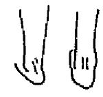 Левая нога в варусном положении (супинация). Вес приходится на внешнюю сторону стоп. Вид сзади