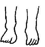 Левая нога в варусном положении (супинация). Вид спереди