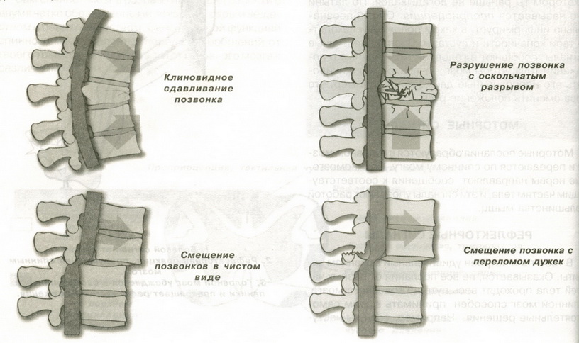 Форма тел позвонков. Передняя клиновидная деформация l3 и l4.. Компрессионный перелом тела позвонка схема. Клиновидный компрессионный перелом позвоночника. Перелом тела позвонка классификация.
