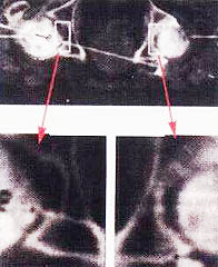 Пример регенерации костной ткани в области остеопороза КТ левого и правого тазобедренных суставов
