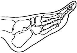 Скиаграмма стопы больного в боковой проекци