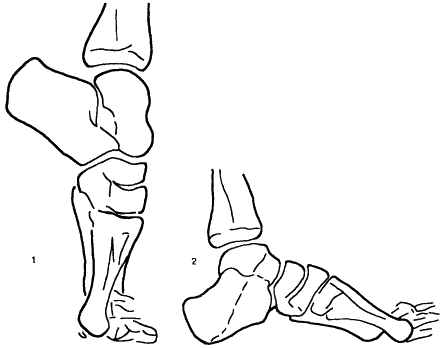 Коррекция эквинуса переднего отдела стопы с помощью клиновидной резекции таранной и пяточной костей