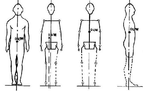 Смещение общего центра массы тела у инвалидов после ампутации нижних конечностей