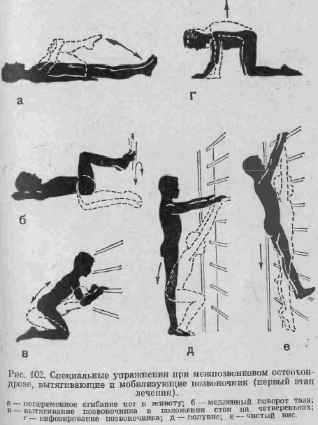 Специальные упражнения, применяемые при остеохондрозах