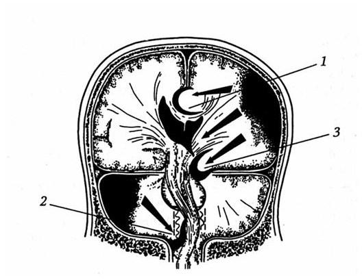 Виды дислокаций головного мозга
