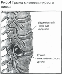 Клинические проявления остеохондроза позвоночника - грыжа межпозвонкового диска