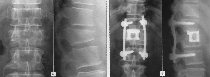 Рентгенограммы до операции; неполный взрывной нестабильный перелом тела L1 позвонка