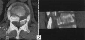 Рентгенограммы через 1 год после транспедикулярного остеосинтеза Т12-L2 позвонков
