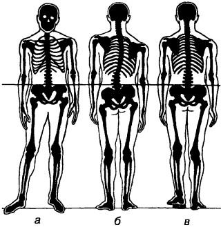 Асимметрия скелета при короткой левой ноге
