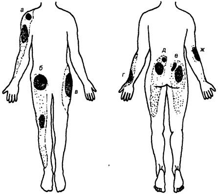 Примеры иррадиации боли из суставных и периартикулярных структур