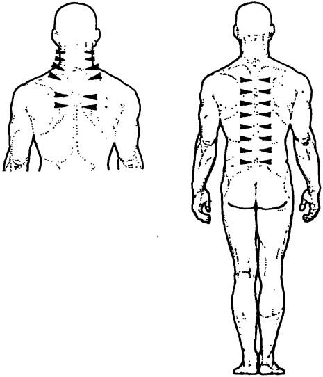 Возможные зоны ЭС при болевых синдромах остеохондроза: шейного, грудного и поясничного