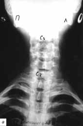 Рентгенограммы шейного отдела позвоночника больной С