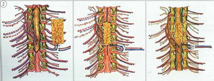 Схема операций перемещения межреберного сосудисто-нервного пучка на дистальные отделы спинного мозга