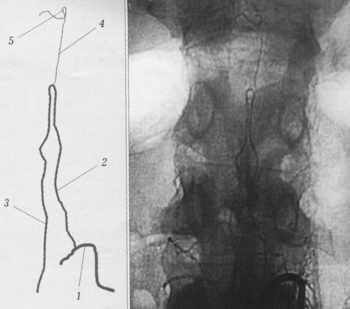 Спинальная ангиограмма больного Л. 29 лет. Окклюзия передней спинальной артерии