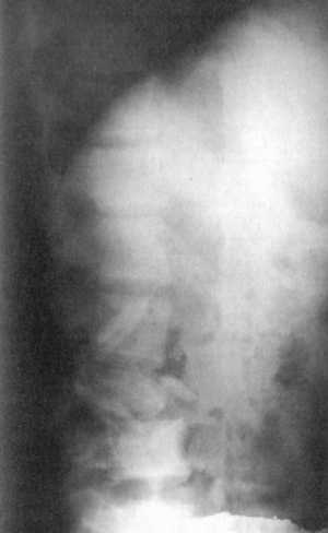 Рентгенограмма после хирургического вмешательства при повреждении L3-позвонка (боковая проекция)