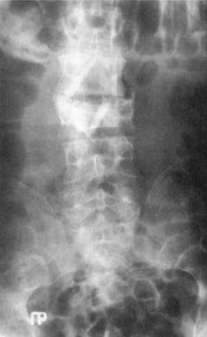 Рентгенограмма после хирургического вмешательства при повреждении L3-позвонка (прямая проекция)