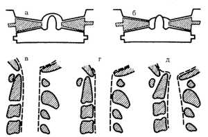Схематическое изображение взаимоотношений верхних шейных позвонков при переломе Джефферсона
