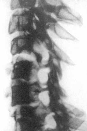 Рентгенограмма шейного отдела позвоночника при левостороннем верховом вывихе С4-позвонка