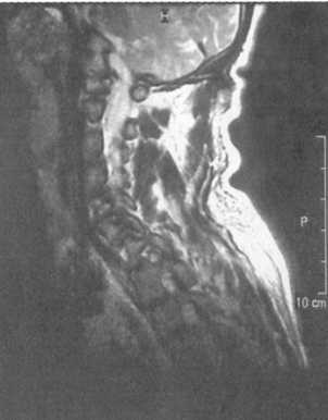 Переломо-вывих скользящий C6-C7 позвонков с компрессией спинного мозга на данном уровне