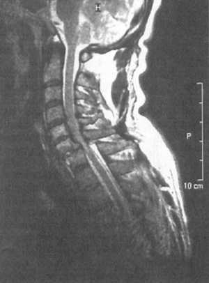 Переломо-вывих скользящий C6-C7 позвонков с компрессией спинного мозга на данном уровне