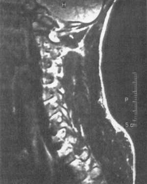 Компрессионный перелом с подвывихом кзади С4 позвонка с зоной ишемии спинного мозга