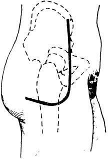 Разрез тканей при вается передняя поверхность шейки остеосинтезе шейки бедра бедра