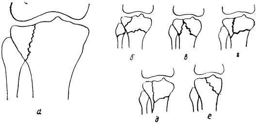 Различные виды переломов проксимального конца большеберцовой кости
