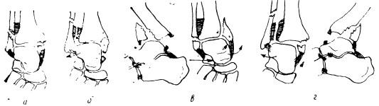 Схема типичных переломов лодыжек