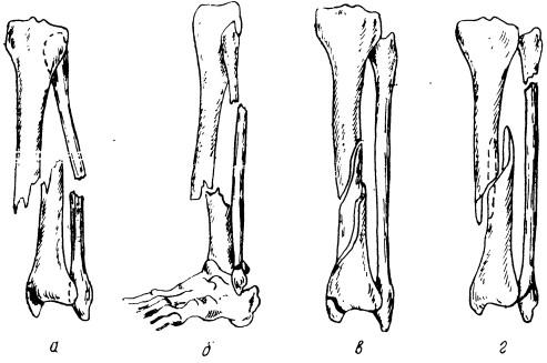 Различные виды диафизарных переломов костей голени, сочетающиеся с переломом лодыжек