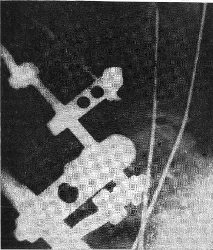 Рентгенограмма больной К. с репонированным задним краем большеберцовой кости