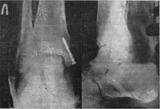 Рентгенограмма больной в гипсовой повязке после остеосин теза перелома внутренней лодыжки винтом