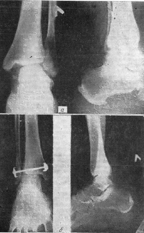 Рентгенограмма больной М. с переломом малоберцовой кости