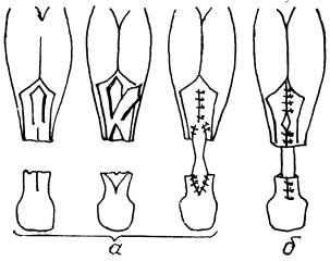 Отделенный апоневротический лоскут пришивают периферийно и центрально к ахиллову сухожилию
