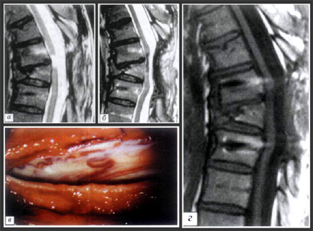 Больной С. Диагноз: травматическая болезнь спинного мозга, последствия перелома Т7 позвонка