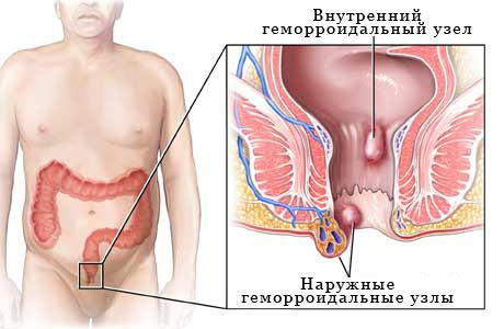 Геморрой - наружные и внутренние геморроидальные узлы