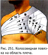 Колосовидная повязка на область плеча
